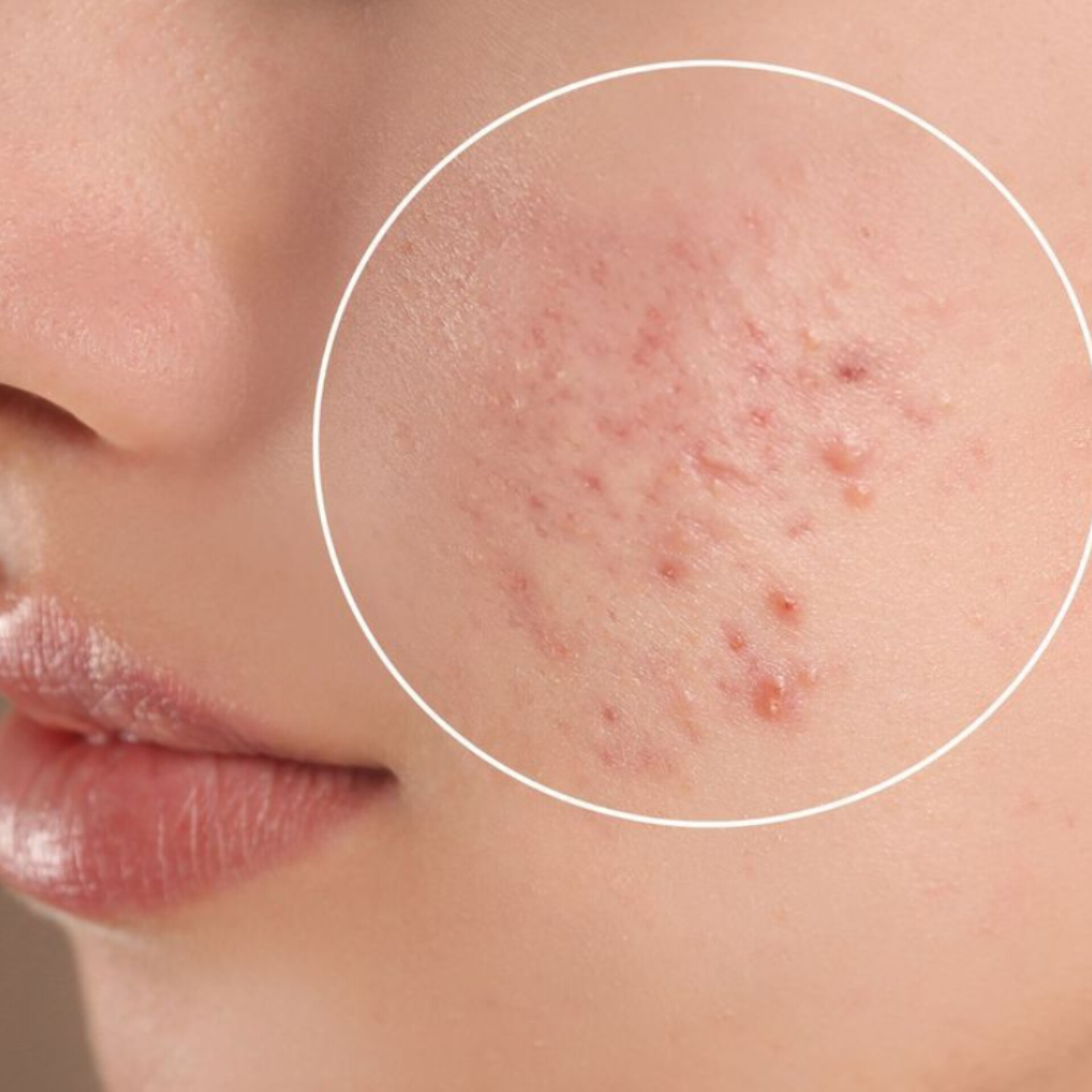 جوش و آکنه چیست؟ دلایل ایجاد جوش و راه‌های مراقبت از پوست